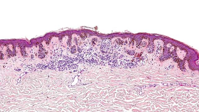 Skin under a microscope, stained pink and purple: a thin top layer with brown pigment along its base, and small clusters of pigment cells just below it.
