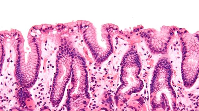 The lining of the stomach under a microscope, stained pink and purple, with deep folds and tightly packed gland cells.