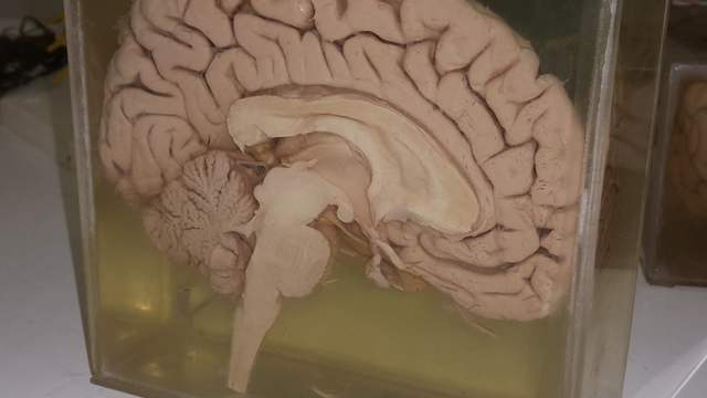 Half of a preserved human brain, cut down the middle, in a clear box of fluid. The folds, the brainstem and the cerebellum at the back show.