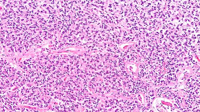 Pink and purple stained tissue under a microscope: tightly packed cells of the pineal gland with small blood vessels between them.