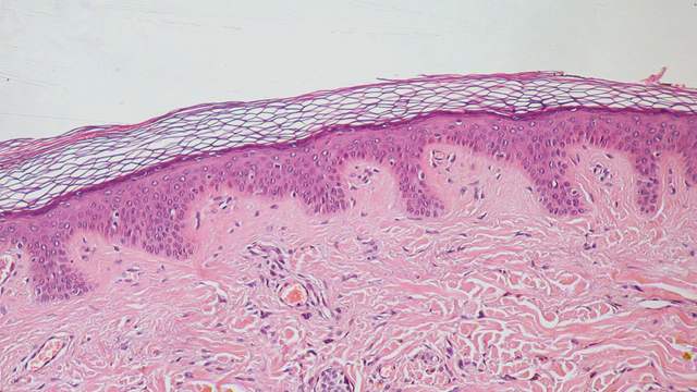 A slice of human skin under a microscope: a thin purple outer layer above a thicker, pale pink layer of fibres, with small clusters of cells from a harmless mole deeper down.