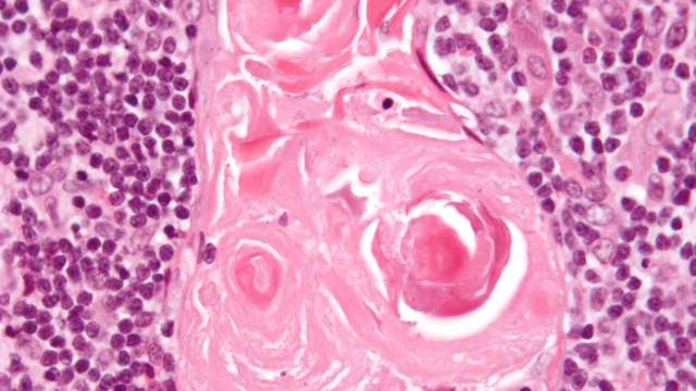 Pink and purple stained tissue under a microscope: a large pink swirl of flattened cells surrounded by many small dark immune cells.